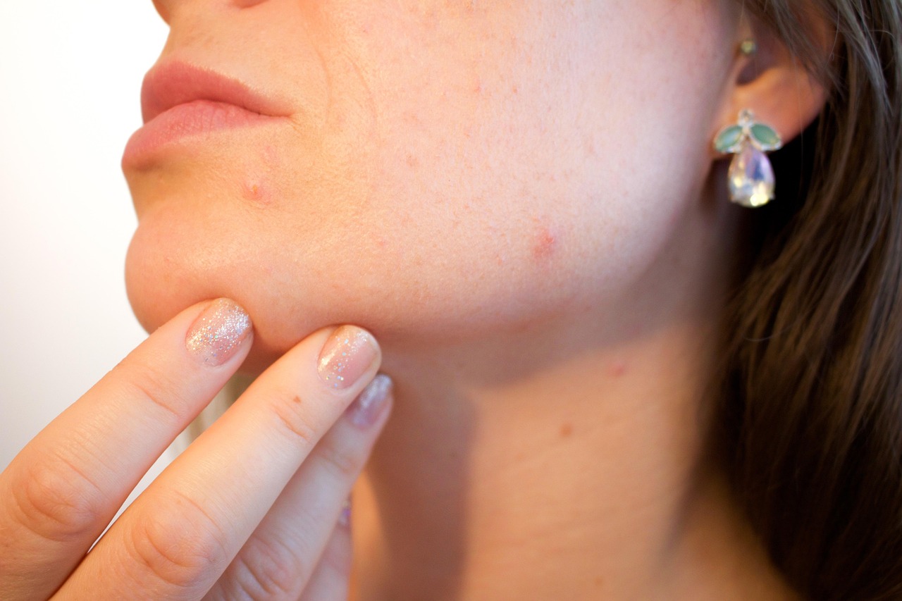 Your Guide to Effective Acne Scar Treatment in Sacramento: Unveiling Microneedling's Power